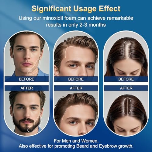 5% Minoxidil Foam for Men with Biotin - 5 Pack, Hair Growth Treatment for Thicker, Fuller Hair & Beard (10.5 oz, 5 Month Supply) Avelisse