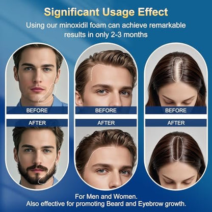 5% Minoxidil Foam for Men with Biotin - 5 Pack, Hair Growth Treatment for Thicker, Fuller Hair & Beard (10.5 oz, 5 Month Supply) Avelisse