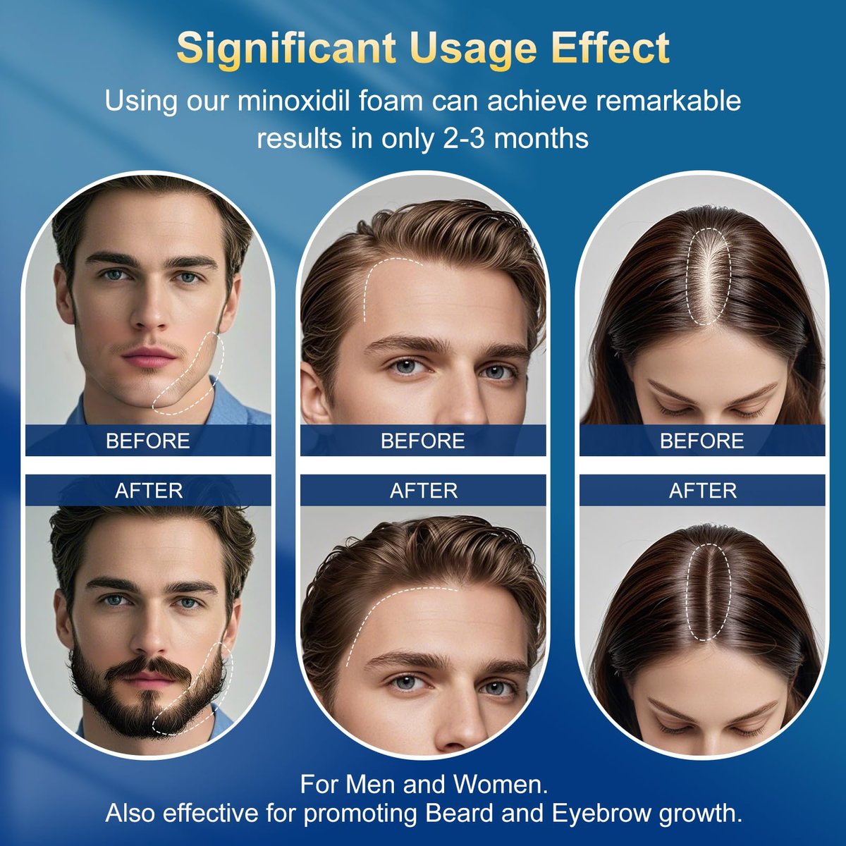 5% Minoxidil Foam for Men with Biotin - 5 Pack, Hair Growth Treatment for Thicker, Fuller Hair & Beard (10.5 oz, 5 Month Supply) Avelisse