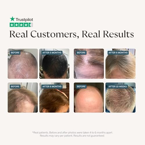 Happy Head Hair Serum for Men & Women – Procapil, Biotin, Ashwagandha & Collagen Leave-In Scalp Treatment for Daily Hair Care, Lightweight 2 Oz Bottle Avelisse