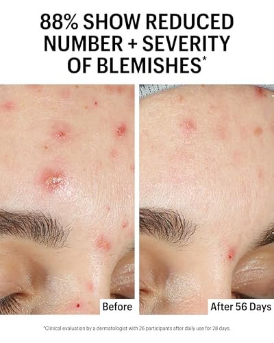 Allies of Skin Azelaic & Kojic Clarifying Face Serum – 10% Azelaic Acid for Acne, Pigmentation & Redness, 1 Fl Oz Avelisse