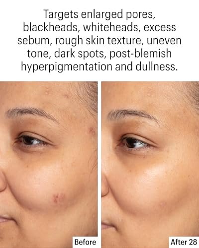 Allies of Skin Azelaic & Kojic Clarifying Face Serum – 10% Azelaic Acid for Acne, Pigmentation & Redness, 1 Fl Oz Avelisse