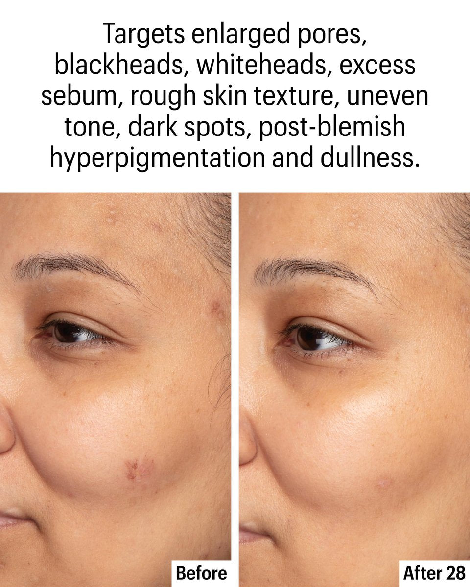 Allies of Skin Azelaic & Kojic Clarifying Face Serum – 10% Azelaic Acid for Acne, Pigmentation & Redness, 1 Fl Oz Avelisse