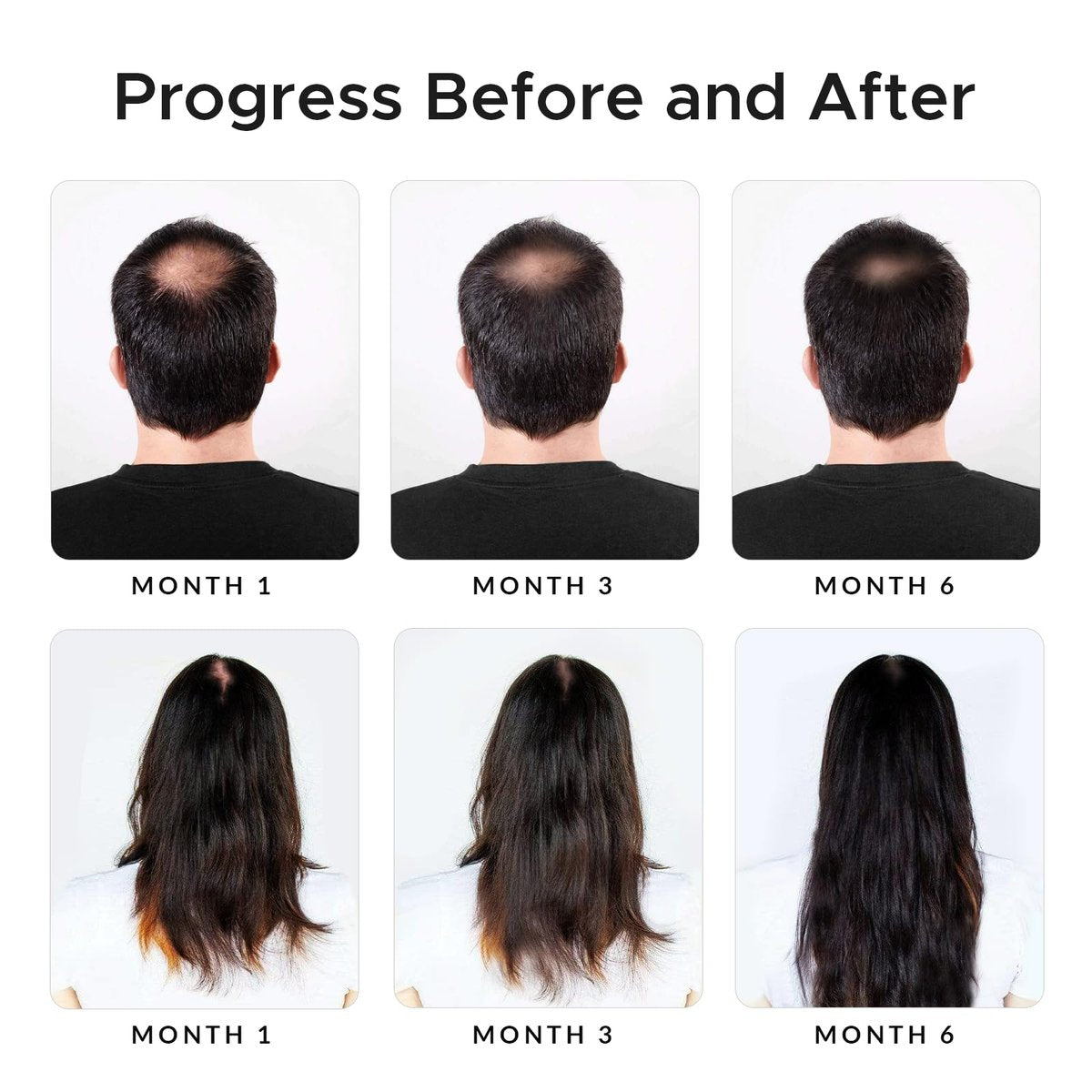 Minoxidil & Biotin Shampoo for Hair Growth - DHT Blocker with Caffeine, Castor Oil & Onion for Thicker, Healthier Hair - Strengthening Formula for Men & Women Avelisse