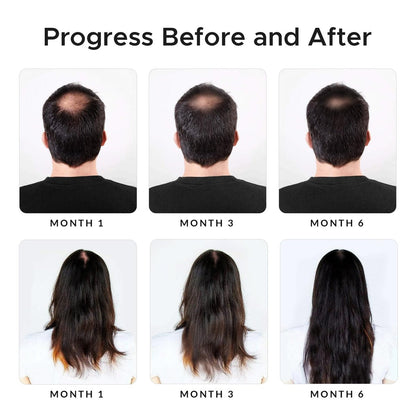 Minoxidil & Biotin Shampoo for Hair Growth - DHT Blocker with Caffeine, Castor Oil & Onion for Thicker, Healthier Hair - Strengthening Formula for Men & Women Avelisse