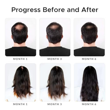 Minoxidil & Biotin Shampoo for Hair Growth - DHT Blocker with Caffeine, Castor Oil & Onion for Thicker, Healthier Hair - Strengthening Formula for Men & Women Avelisse
