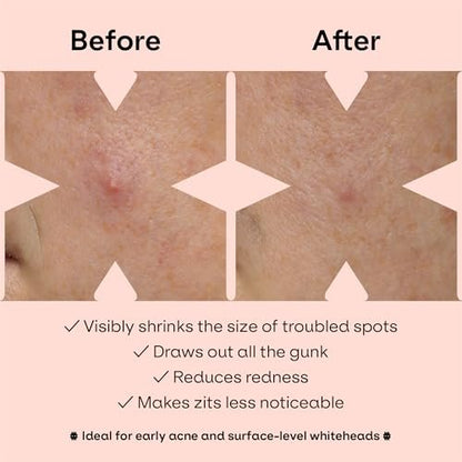 ZVYK Pimple Patches Cute for Face (28 Unique Acne Patch Designs) | Hydrocolloid, Salicylic Acid, Tea Tree | Strong Adhesion, Waterproof, Vegan | Confidence Patch Be You