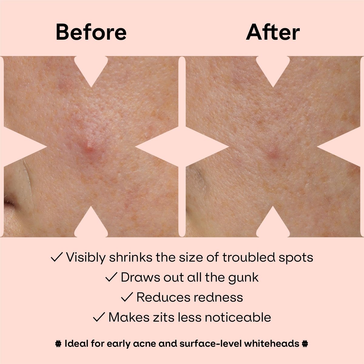 ZVYK Pimple Patches Cute for Face (28 Unique Acne Patch Designs) | Hydrocolloid, Salicylic Acid, Tea Tree | Strong Adhesion, Waterproof, Vegan | Confidence Patch Be You - görsel 7