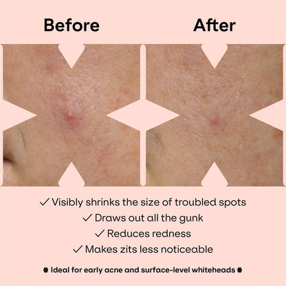 ZVYK Pimple Patches Cute for Face (28 Unique Acne Patch Designs) | Hydrocolloid, Salicylic Acid, Tea Tree | Strong Adhesion, Waterproof, Vegan | Confidence Patch Be You