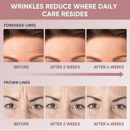 Chialing Forehead Wrinkle Patches – Reusable Overnight Smoothing Silicone Tape with Lavender Oil, Reduce Fine Lines & Prevent Creases, Non-Invasive Facial Pads, Pack of 4 Avelisse
