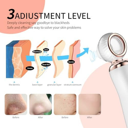 2025 Blackhead Remover Pore Vacuum - Visual Rechargeable Facial Pore Cleaner with 3 Suction Silicone Heads, 3 Probes, USB Kit - Electric Acne Extractor Tool for Adults, White