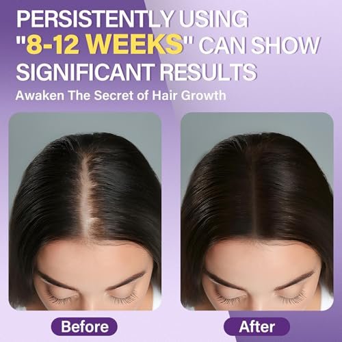 Greoay 5% Minoxidil Foam for Women - Hair Regrowth Treatment, 6.35 oz Avelisse