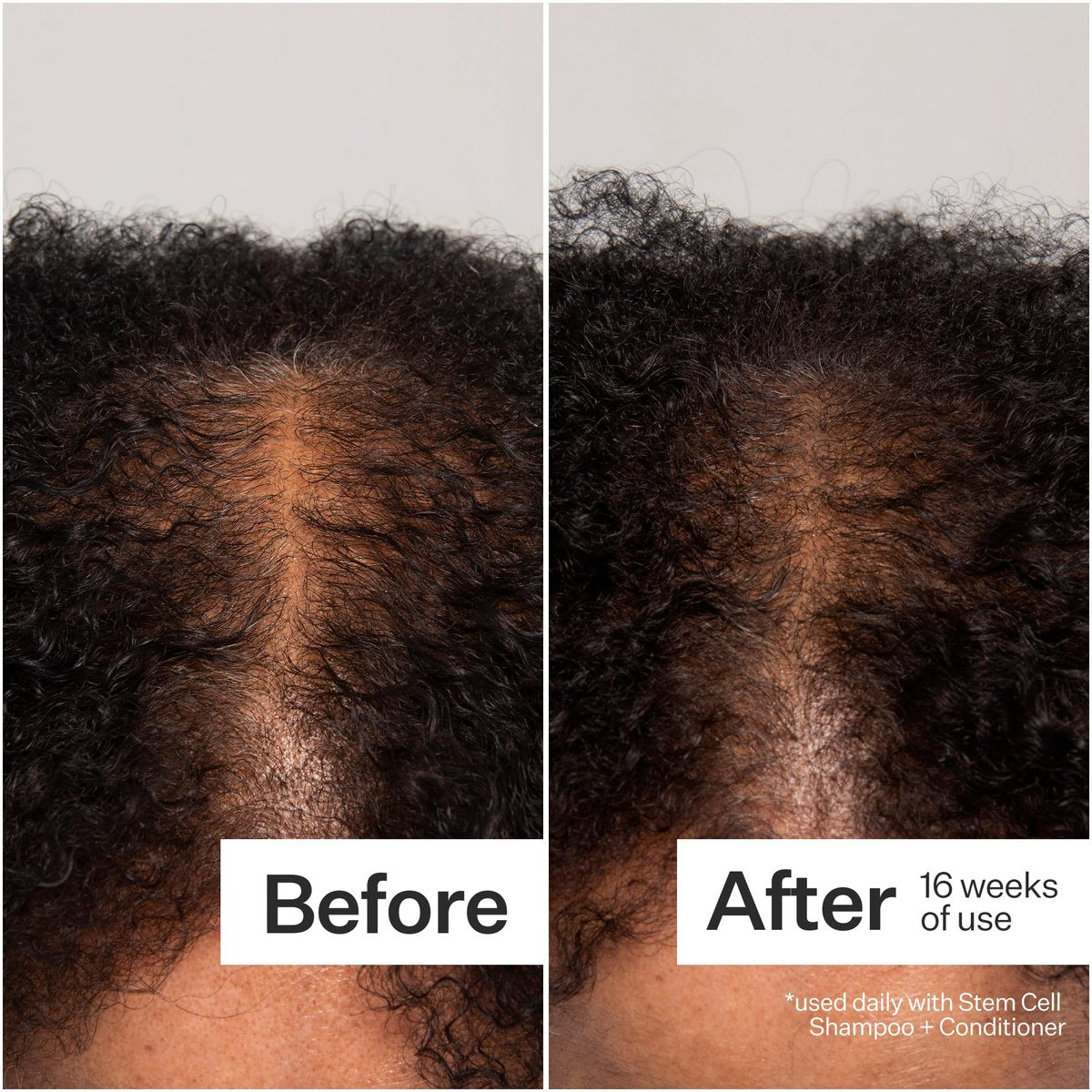 Act+ Acre Cold Processed 3% Stem Cell Peptide Treatment - Boosts Hair Density - Grape Stem Cells, Peptides + Caffeine - Vegan, Fragrance-Free - 3 Fl Oz Avelisse