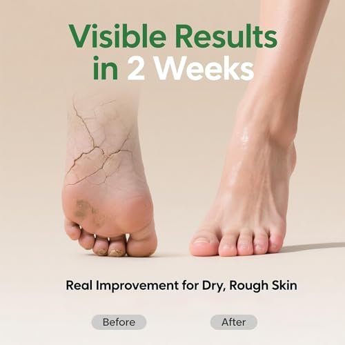 ZyraGloz 60% Urea Cream with 2% Salicylic Acid – Maximum Strength Moisturizer for Dry, Cracked Heels, Feet, Hands, Knees & Elbows – Callus Remover – 10.1 fl oz Avelisse