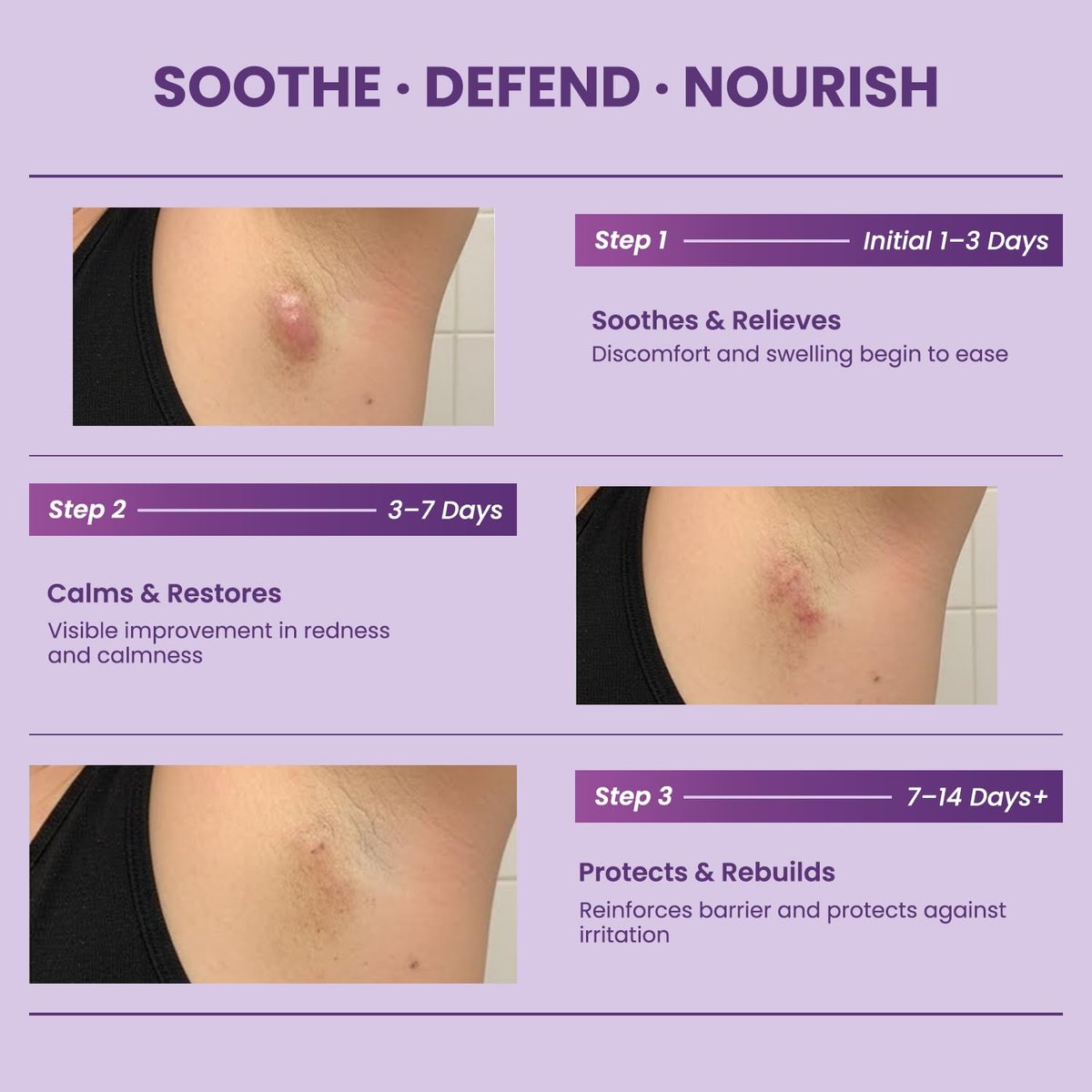 Easment Hidradenitis Suppurativa Flare Defense Balm - Science-Backed Daily Protection for Flare-Prone, Bump-Prone Skin with Microsilver BG™, Zinc Oxide & Botanical Blend, 2 oz Avelisse