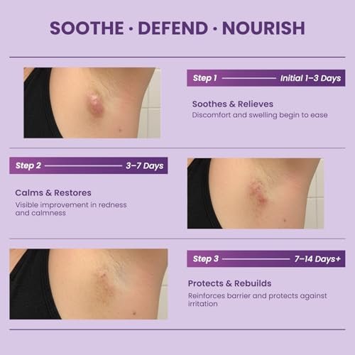 Easment Hidradenitis Suppurativa Flare Defense Balm - Science-Backed Daily Protection for Flare-Prone, Bump-Prone Skin with Microsilver BG™, Zinc Oxide & Botanical Blend, 2 oz Avelisse