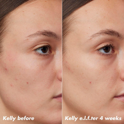 e.l.f. SKIN PLZ Clarify Facial Oil - Acne Treatment Face Oil with Salicylic Acid, Vegan & Cruelty-Free, 1 oz Avelisse