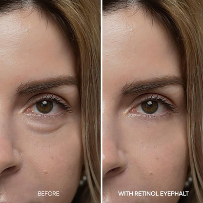 Dr.Melaxin Retinol Eyebag Cream – Puffiness, Dark Circles & Fine Lines Treatment with EGF, Niacinamide & Ceramide, 0.35 Fl Oz Avelisse