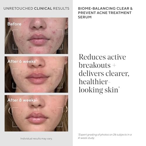 Murad Biome-Balancing Acne Treatment – Salicylic, Mandelic & Glutamic Acid Serum for Clearing Breakouts, Decongesting Pores & Balancing Skin Microbiome – 1.0 Fl Oz Avelisse