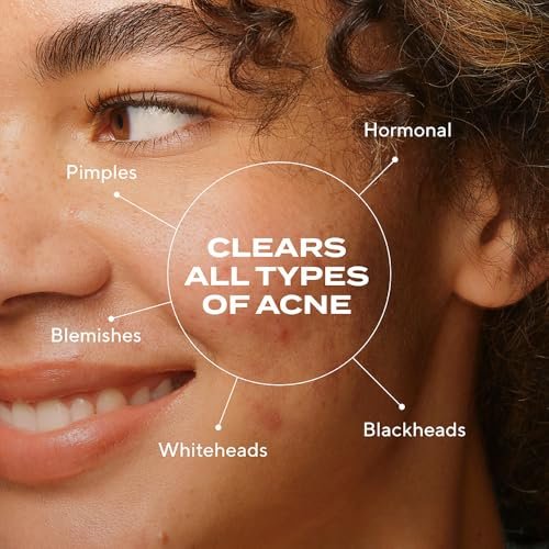 Murad Biome-Balancing Acne Treatment – Salicylic, Mandelic & Glutamic Acid Serum for Clearing Breakouts, Decongesting Pores & Balancing Skin Microbiome – 1.0 Fl Oz Avelisse