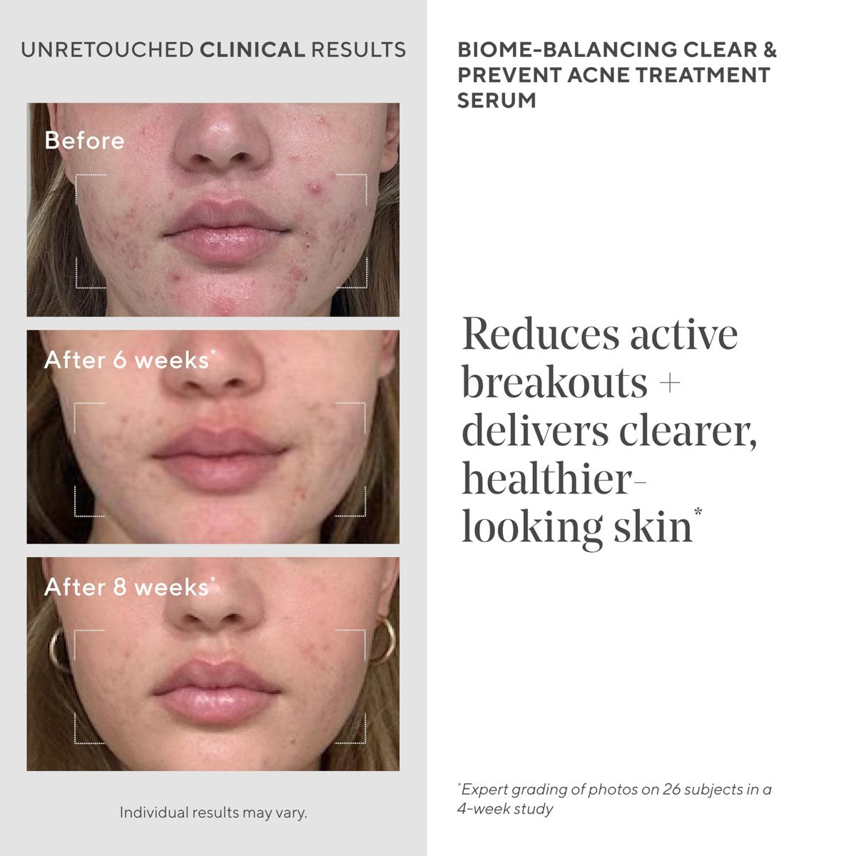 Murad Biome-Balancing Acne Treatment – Salicylic, Mandelic & Glutamic Acid Serum for Clearing Breakouts, Decongesting Pores & Balancing Skin Microbiome – 1.0 Fl Oz Avelisse