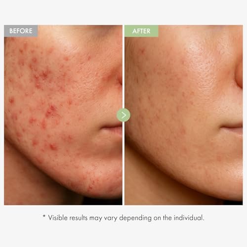 TOSOWOONG Exosome CICA Face Cream - Daily Soothing Moisturizer for Breakouts and Irritated Skin, Fast-Acting, Lightweight Korean Skincare for Redness and Blemish-Prone Skin, 50ml / 1.69 fl. oz. Avelisse