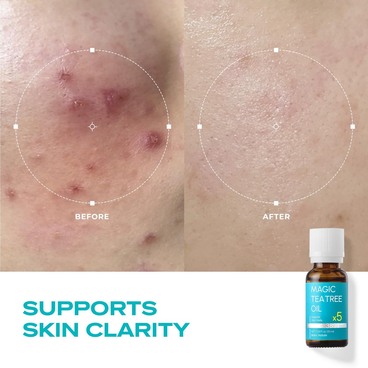 BLANC NATURE Magic Tea Tree Oil Spot Care for Face - Clarifying Facial Oil for Oily & Sensitive Skin, Lightweight & Fast Absorption, Vegan Korean Skincare, 0.68 fl oz (20ml) Avelisse