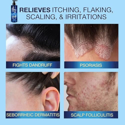 Uttse Anti-Fungal Shampoo for Scalp Psoriasis, Dandruff, Folliculitis & Seborrheic Dermatitis – Relieves Itchy & Dry Scalp – 300 mL / 10.1 fl.oz Avelisse