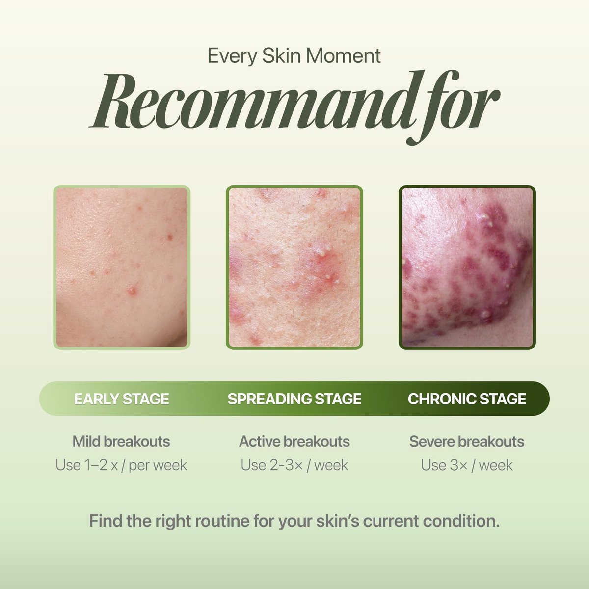 EIOM Trouble Patch Mask – Full Face Hydrocolloid Mask for Acne-Prone Skin | Absorbs Oil & Buildup with Tea Tree Biome Complex (20ml x 4) Avelisse