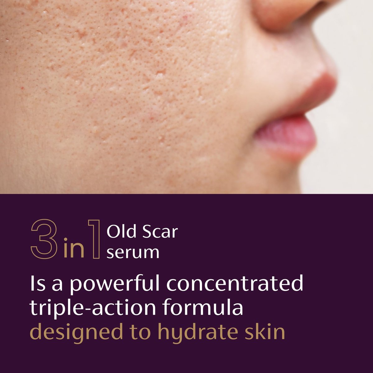 Mederma Scar Serum – Triple-Action Formula with Vitamin E, Hyaluronic Acid & Niacinamide – Clinically Shown to Reduce Old Scars, 1 Fl. Oz. - görsel 9