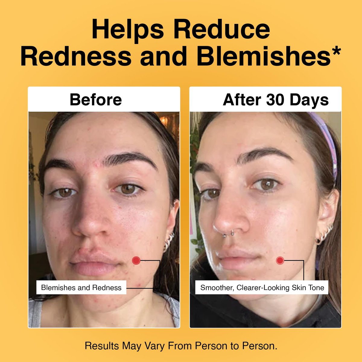 Foundation Skincare Azelaic Acid for Face 14% (1 Fl Oz) – Dermatologist Formula for Uneven and Blemish-Prone Skin, Supports Balanced Tone & Smooth Texture for Men & Women Avelisse