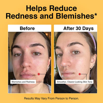 Foundation Skincare Azelaic Acid for Face 14% (1 Fl Oz) – Dermatologist Formula for Uneven and Blemish-Prone Skin, Supports Balanced Tone & Smooth Texture for Men & Women Avelisse