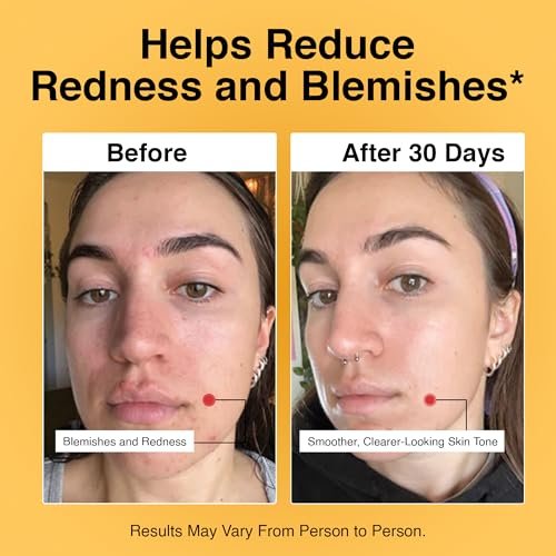 Foundation Skincare Azelaic Acid for Face 14% (1 Fl Oz) – Dermatologist Formula for Uneven and Blemish-Prone Skin, Supports Balanced Tone & Smooth Texture for Men & Women Avelisse