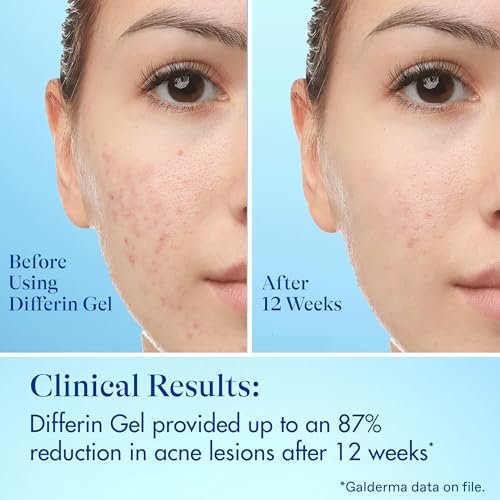 Differin Acne Fighter Pack: Retinoid Gel + Salicylic Acid Pimple Patches for Acne-Prone Skin Avelisse