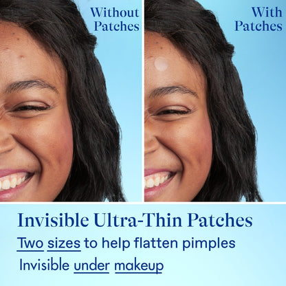 Differin Acne Fighter Pack: Retinoid Gel + Salicylic Acid Pimple Patches for Acne-Prone Skin Avelisse