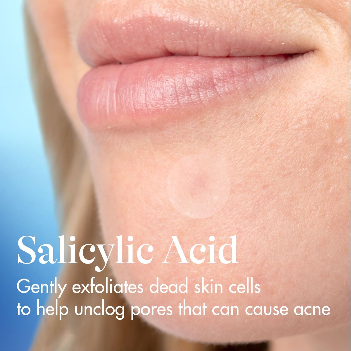 Differin Acne Fighter Pack: Retinoid Gel + Salicylic Acid Pimple Patches for Acne-Prone Skin Avelisse