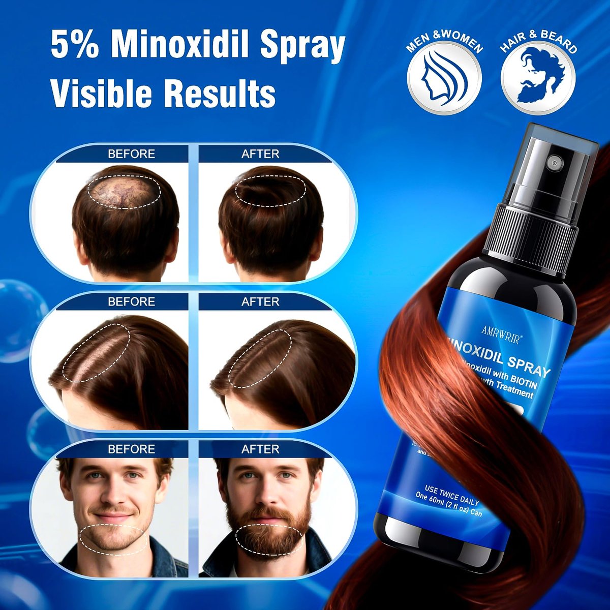 5% Minoxidil Spray for Men and Women with Biotin – Hair Growth Treatment for Thicker Fuller Hair & Beard (6 Pack, 12 Fl Oz Total, 6 Month Supply) Avelisse