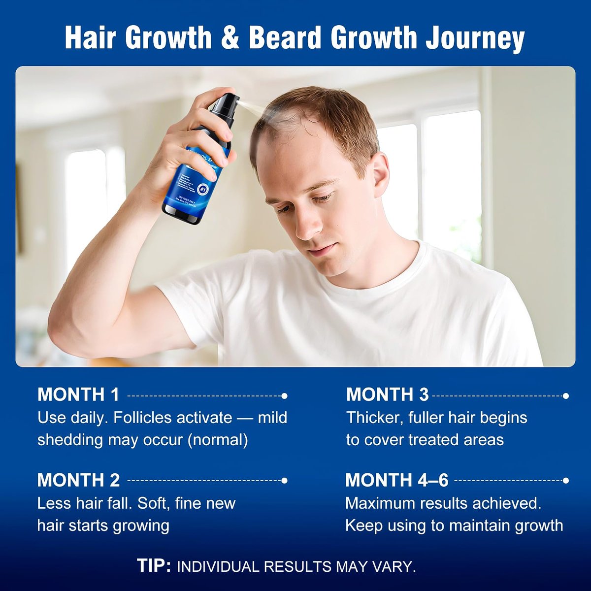 5% Minoxidil Spray for Men and Women with Biotin – Hair Growth Treatment for Thicker Fuller Hair & Beard (6 Pack, 12 Fl Oz Total, 6 Month Supply) Avelisse