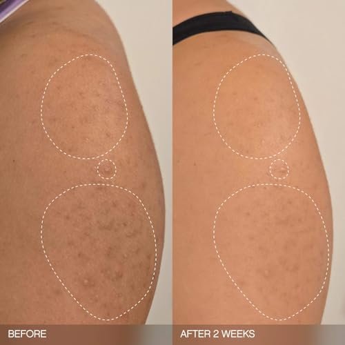 Slather Exfoliating & Smoothing Bar (2 Pack) – Retinol Body Bar for KP, Dry & Textured Skin – Hydrating, Smoothing, Gentle Exfoliation – Safe for Sensitive Skin – Light Lavender Scent Avelisse