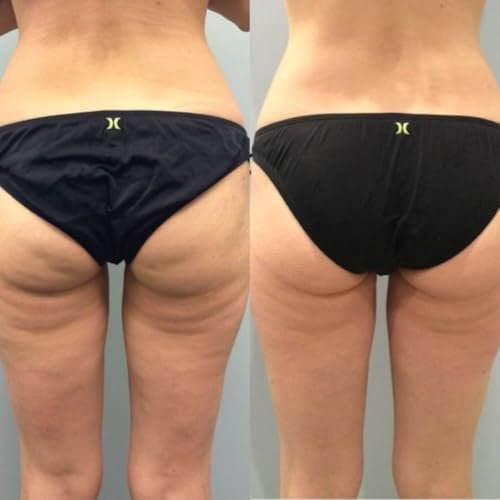 2-Pack Brazilian Body Firming Cream – Advanced Lifting & Tightening Formula, Visibly Reduces Cellulite & Stretch Marks, Intense Hydration for Legs, Arms & Body, Value Bundle 8 oz Each - görsel 10