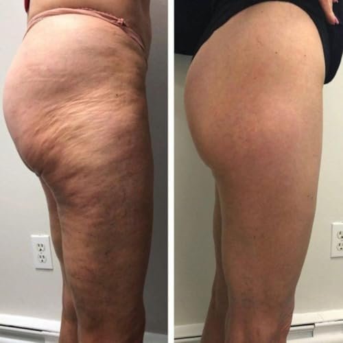 2-Pack Brazilian Body Firming Cream – Advanced Lifting & Tightening Formula, Visibly Reduces Cellulite & Stretch Marks, Intense Hydration for Legs, Arms & Body, Value Bundle 8 oz Each - görsel 8
