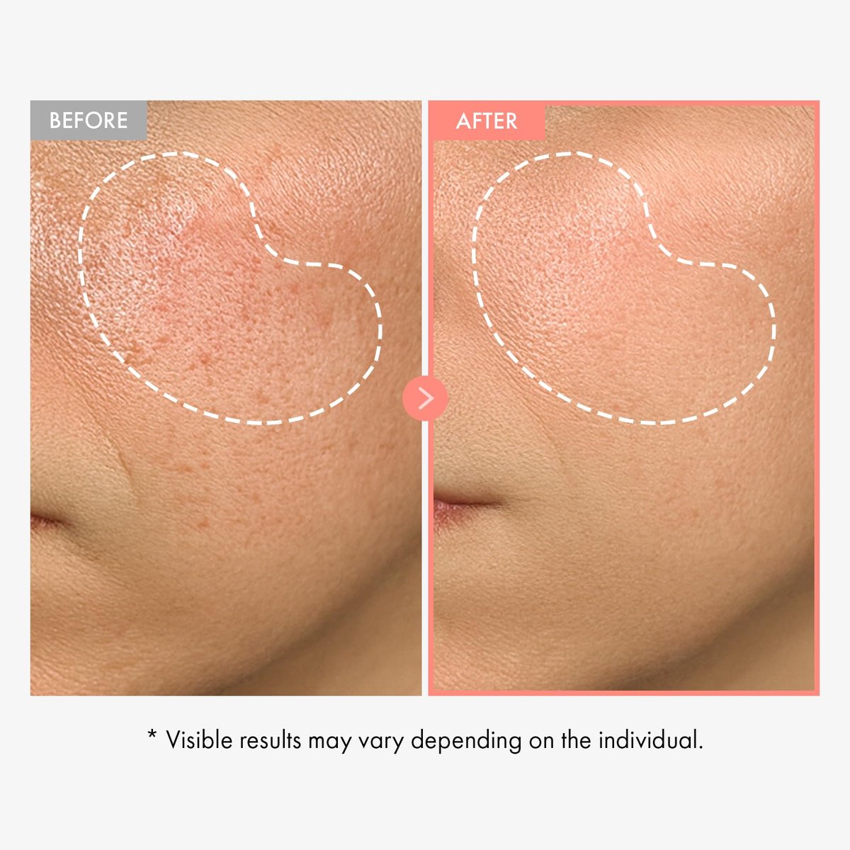 TOSOWOONG Peach 80 Niacin Serum - 5% Niacinamide, Alpha-Arbutin, Vitamin B12 - Hydrating Face Serum for Dark Spots, Pore Minimizer, Uneven Tone, Dullness - Korean Skincare, 33ml - görsel 5