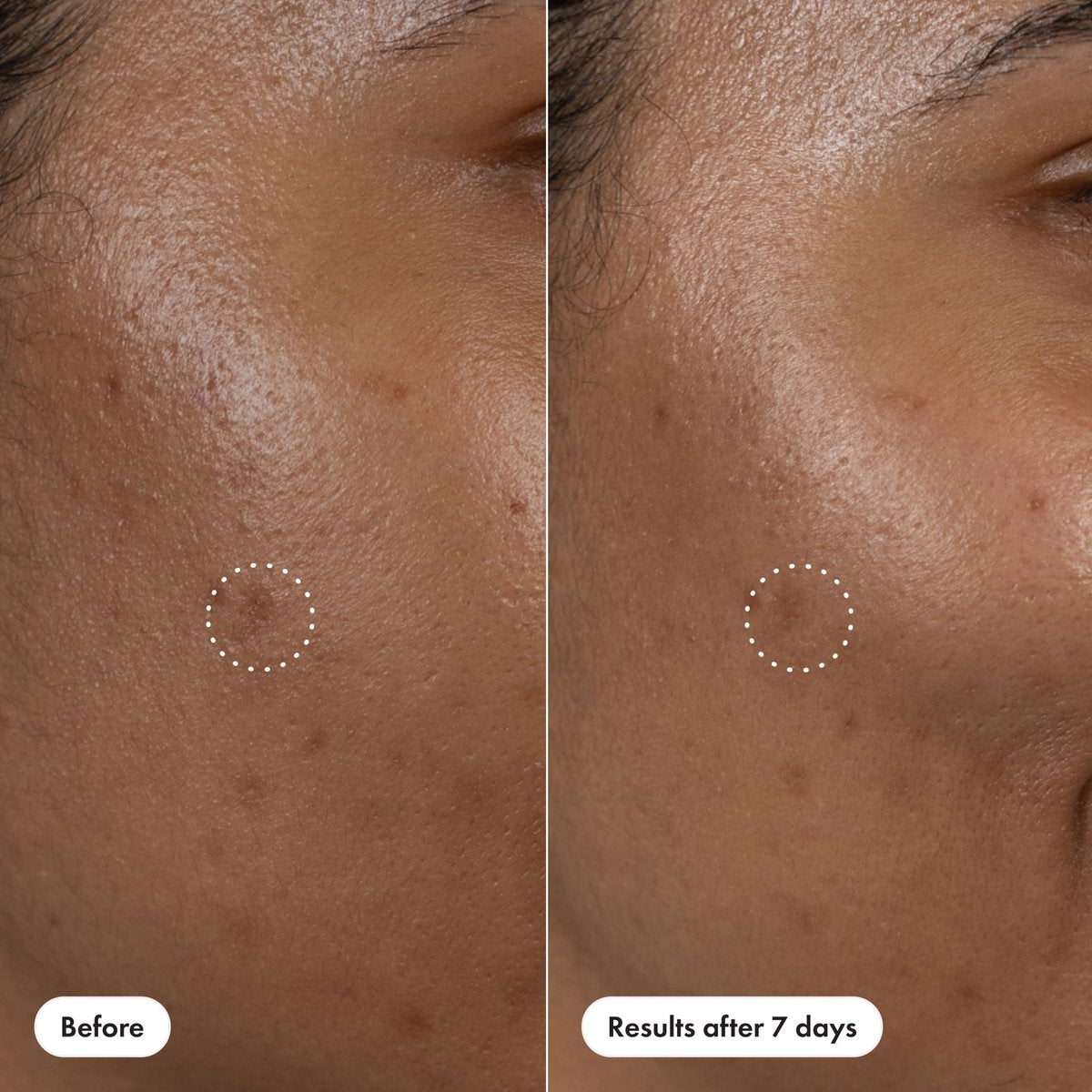 Hero Cosmetics Dark Spot Correct Spot-Fading 15% Vitamin C Serum with Hyaluronic Acid – Improves Post-Blemish Marks in 7 Days – Twist Applicator & Rollerball Tip – 10mL - görsel 13
