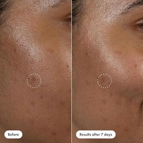 Hero Cosmetics Dark Spot Correct Spot-Fading 15% Vitamin C Serum with Hyaluronic Acid – Improves Post-Blemish Marks in 7 Days – Twist Applicator & Rollerball Tip – 10mL - görsel 14