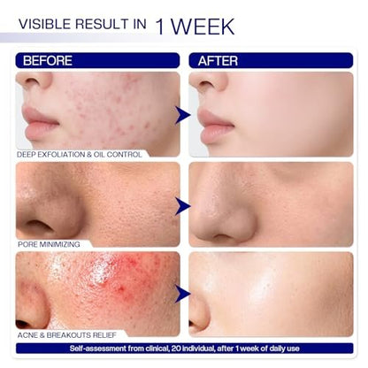 Morovan Glycolic Acid Pads 30%: Dual-Sided Face Exfoliator for Blemishes and Deep Cleaning, Clarifying Skin Tone, At-Home Peel, 65 Pads Avelisse