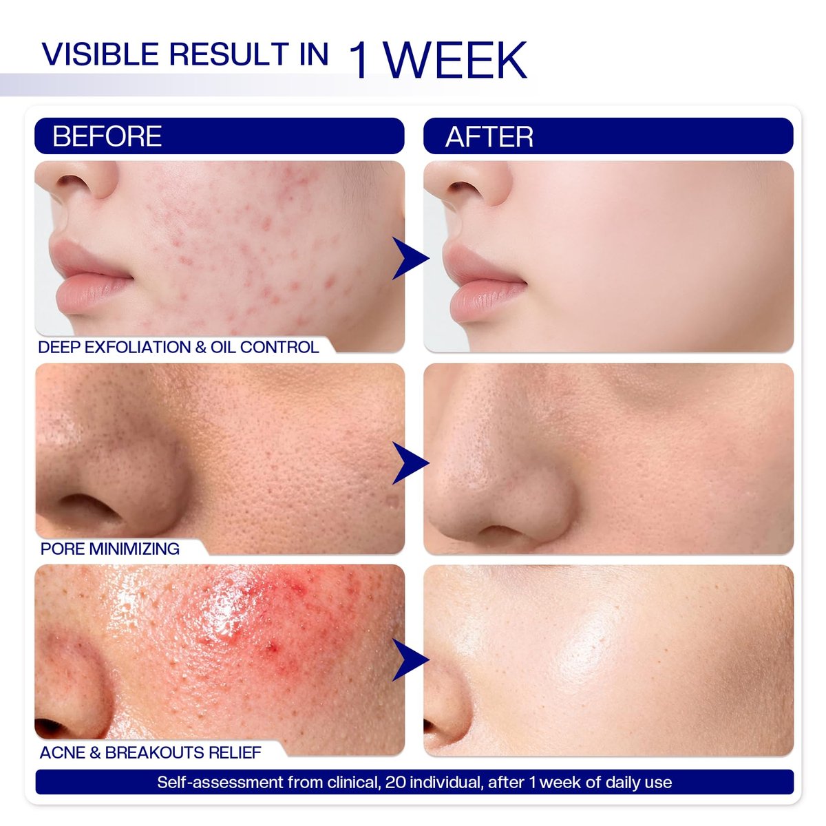 Morovan Glycolic Acid Pads 30%: Dual-Sided Face Exfoliator for Blemishes and Deep Cleaning, Clarifying Skin Tone, At-Home Peel, 65 Pads Avelisse