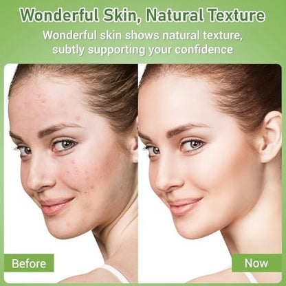 Eofot 14% Azelaic Acid Acne Cream – Helps Improve Appearance of Acnes, Acido Azelaico Face Moisturizer for Sensitive, Oily, Dry Skin, 1 Fl Oz