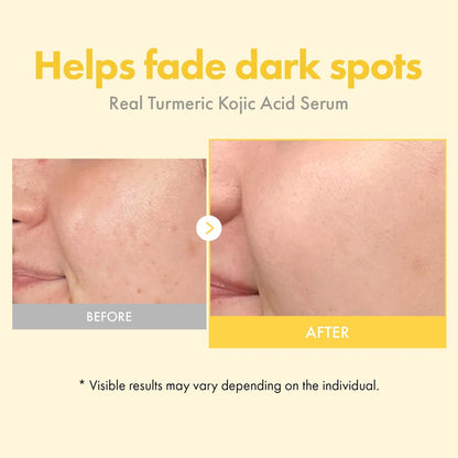 TOSOWOONG Real Turmeric Kojic Acid Serum - Brightening Serum with 7,000ppm Kojic Acid, 1,500ppm Turmeric, Alpha Arbutin, Astaxanthin, Glycolic Acid - Dark Spots & Freckle Corrector - Korean Skin Care, 33ml/1.11 fl.oz. Avelisse