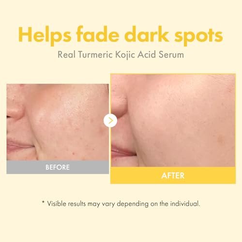TOSOWOONG Real Turmeric Kojic Acid Serum - Brightening Serum with 7,000ppm Kojic Acid, 1,500ppm Turmeric, Alpha Arbutin, Astaxanthin, Glycolic Acid - Dark Spots & Freckle Corrector - Korean Skin Care, 33ml/1.11 fl.oz. Avelisse