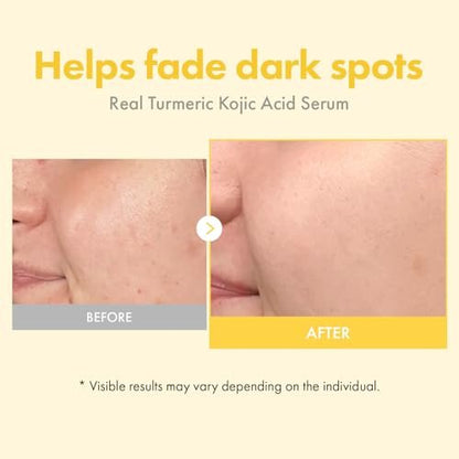TOSOWOONG Real Turmeric Kojic Acid Serum - Brightening Serum with 7,000ppm Kojic Acid, 1,500ppm Turmeric, Alpha Arbutin, Astaxanthin, Glycolic Acid - Dark Spots & Freckle Corrector - Korean Skin Care, 33ml/1.11 fl.oz. Avelisse